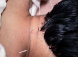 Dry needling neck