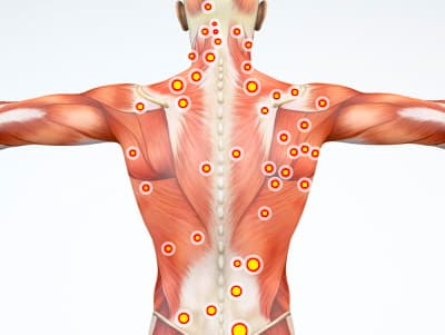 Link to page about muscular trigger points
