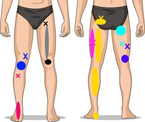 Trigger points with referral zones in legs