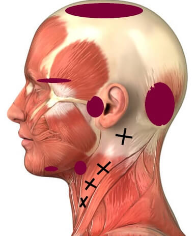 head and neck muscles with crosses for trigger points in sternocleidomastoid