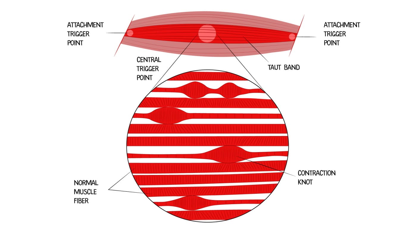 Magnified view of a trigger point