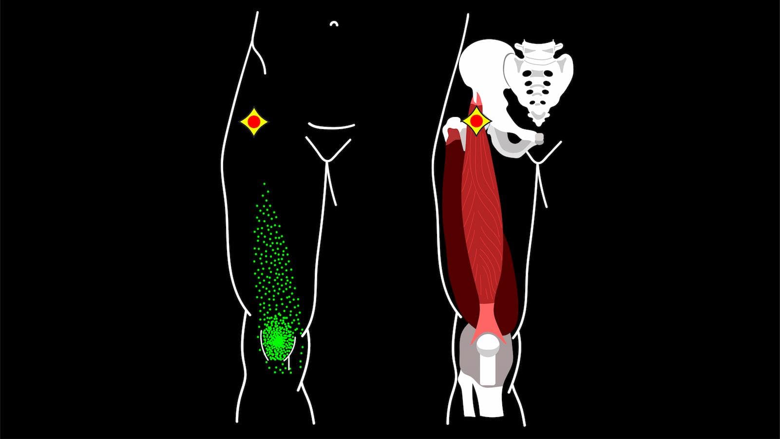 Quad muscle referring pain to knee